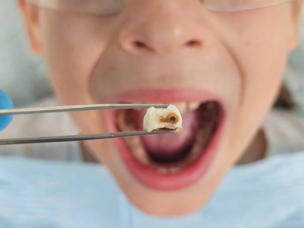 Best Emergency Root Canal Treatment in Montgomery, TX